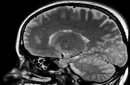 Upozorenje lekara: Simptom tumora na mozgu mogao bi se pojaviti za vreme jela