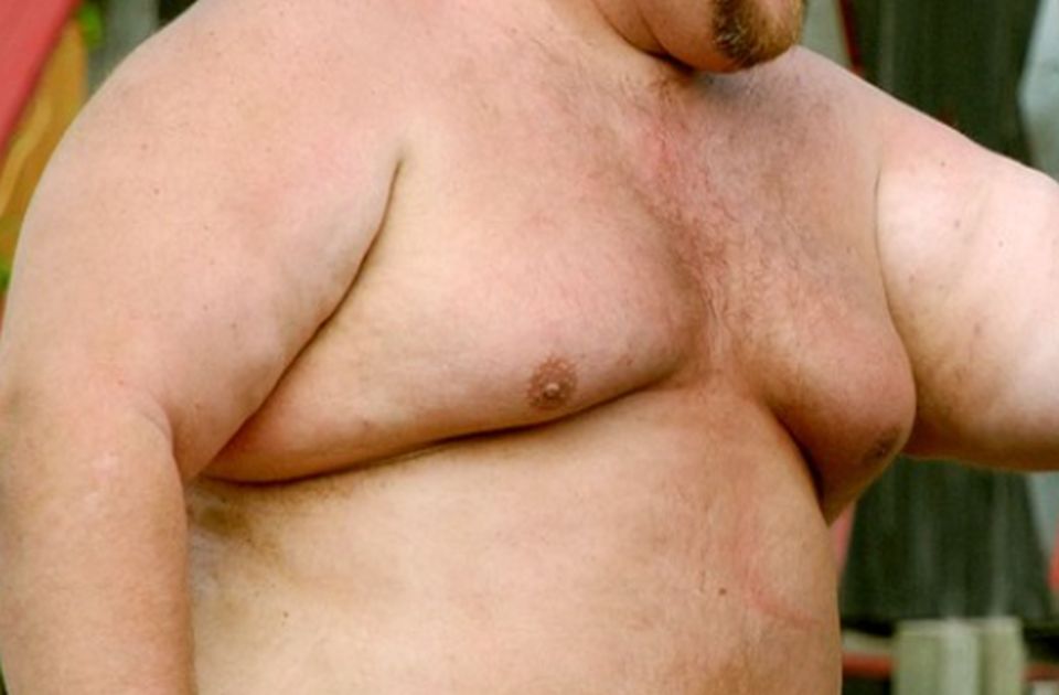 Povećane grudi kod muškaraca mogu biti znak ozbiljne bolesti