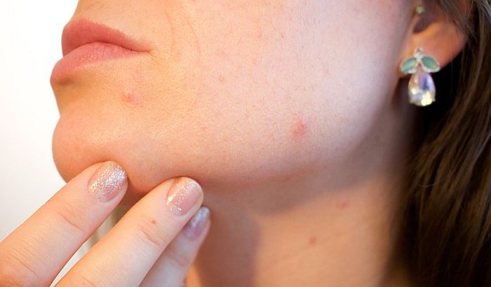 Znaci da bi trebalo da posetite dermatologa