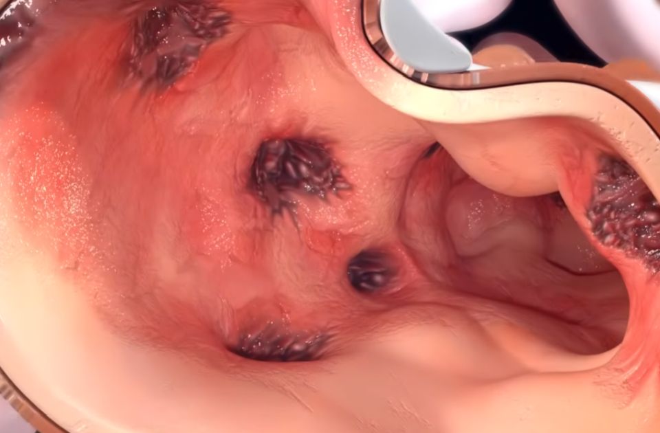 VIDEO: Većina ljudi do 80. godine razvije divertikulozu u crevima - šta je to?