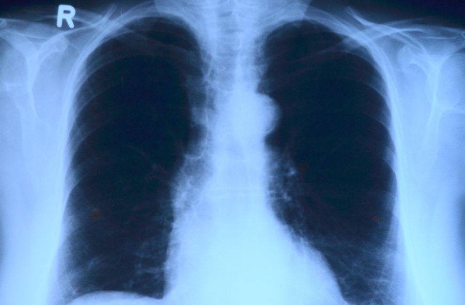 SZO: Rak pluća je ponovo najčešći rak