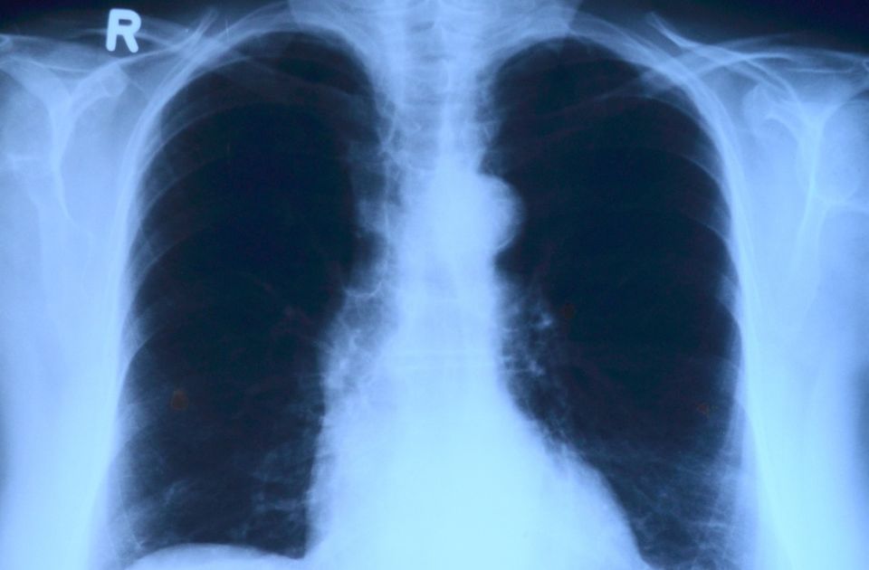 Veštačka inteligencija može da otkrije rak pluća mesecima unapred iz osnovnih medicinskih analiza Veštačka inteligencija može da otkrije rak pluća mesecima unapred iz osnovnih medicinskih analiza