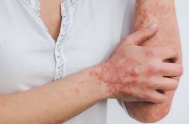 U Srbiji 140.000 obolelih od psorijaze: Razgovor sa dermatologom prvi korak