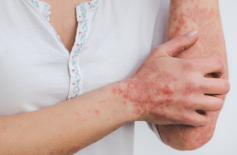 Svetski dan borbe protiv psorijaze: Bolest koja se može kontrolisati, važni pregledi kod dermatologa