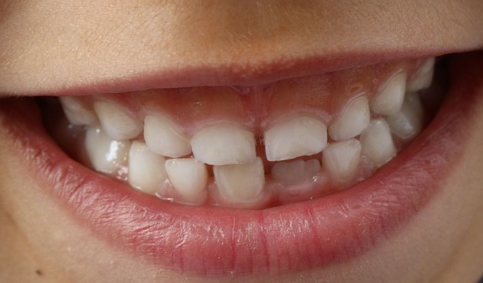 Sve više dece ima krive zube jer ne žvaću hranu, već je gutaju