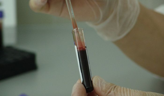 Oko 900 ljudi u Srbiji boluje od urođene hemofilije