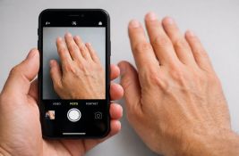 Fotografija vaše ruke mogla bi otkriti redak zdravstveni poremećaj