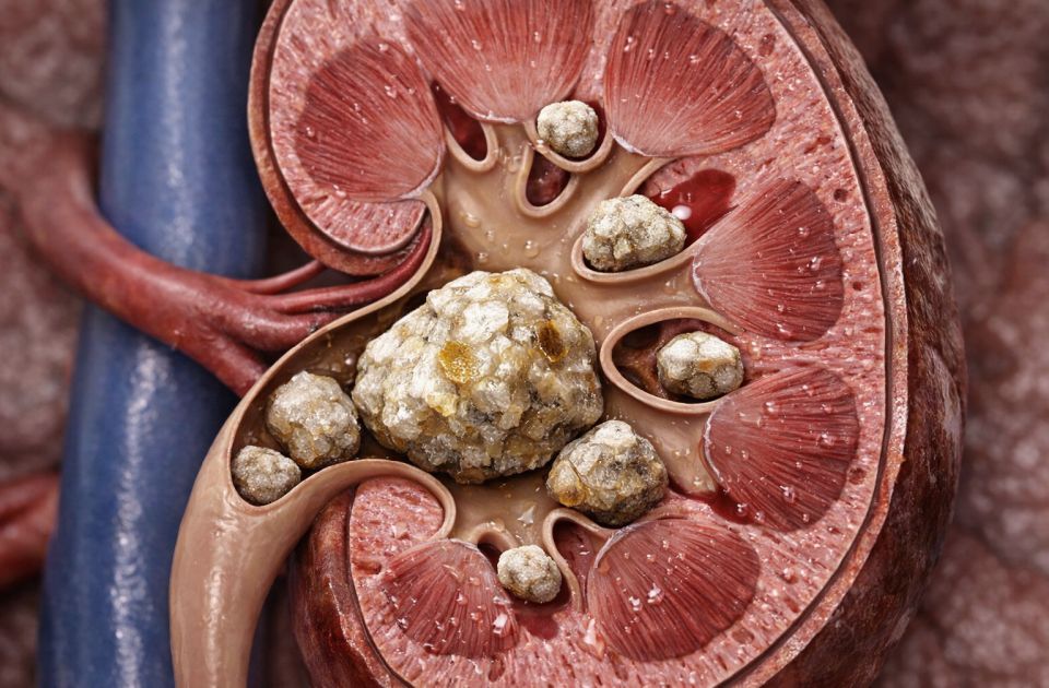 Otkrivene bakterije unutar bubrežnog kamenja