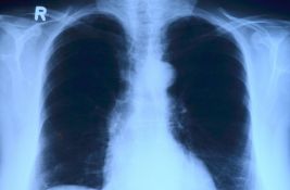 U Srbiji od raka pluća svaka dva sata umre jedna osoba, glavni faktor rizika - pušenje