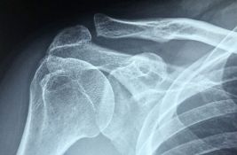 Osteoporoza je 