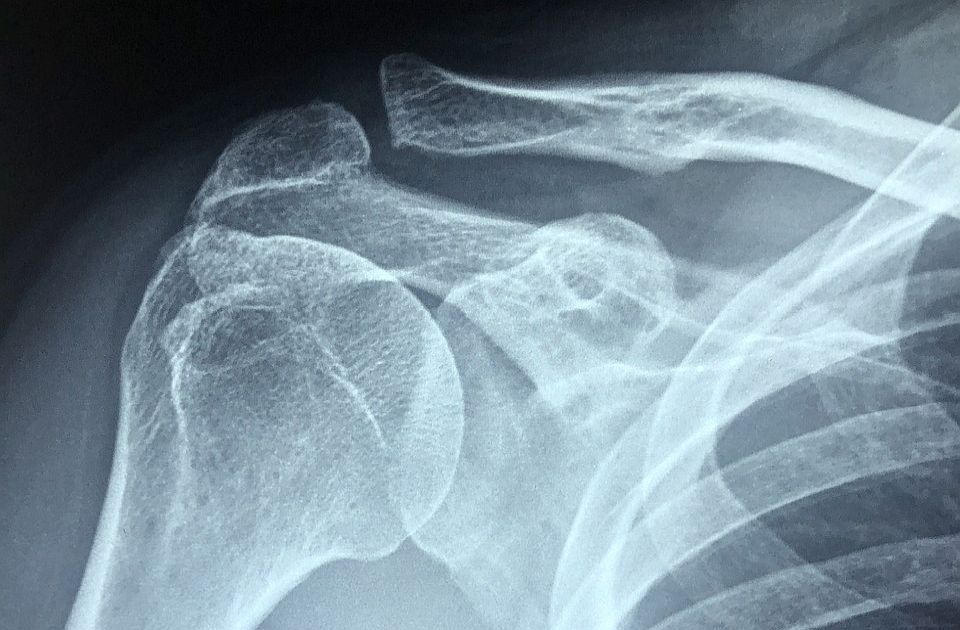 Osteoporoza je "tiha" bolest: Kako ojačati kosti i sačuvati ih od preloma?
