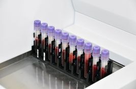 Laboratorijske analize u starijem dobu: Koji nalazi su važni i kako pravilno tumačiti rezultate
