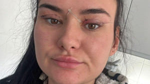 'Ne mogu da zatvorim oči': Žene upozoravaju na jeftine zahvate na kapcima